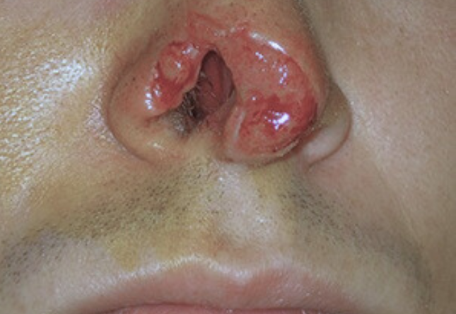 Avant menton/jawline