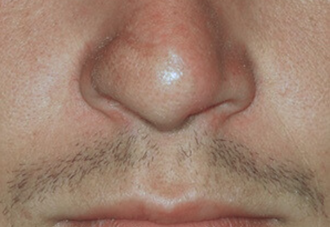 Après menton/jawline