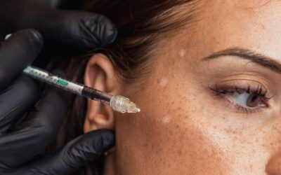 Effet figé après le Botox : pourquoi ça arrive et comment l’éviter ?