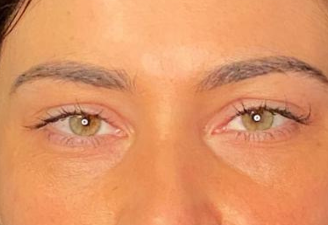 Avant blépharoplastie