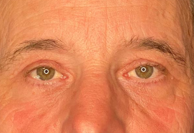 Après blépharoplastie