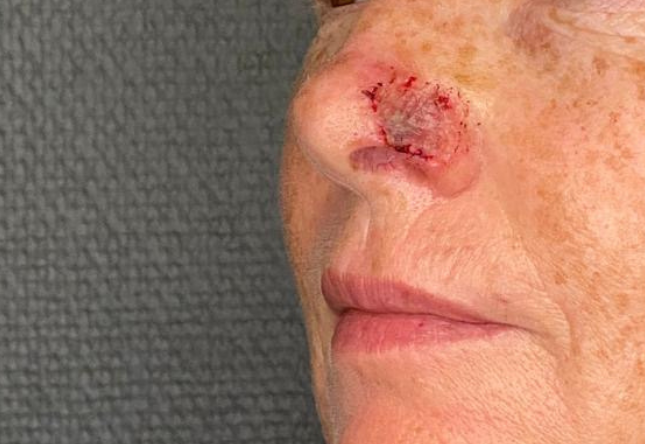 Avant menton/jawline