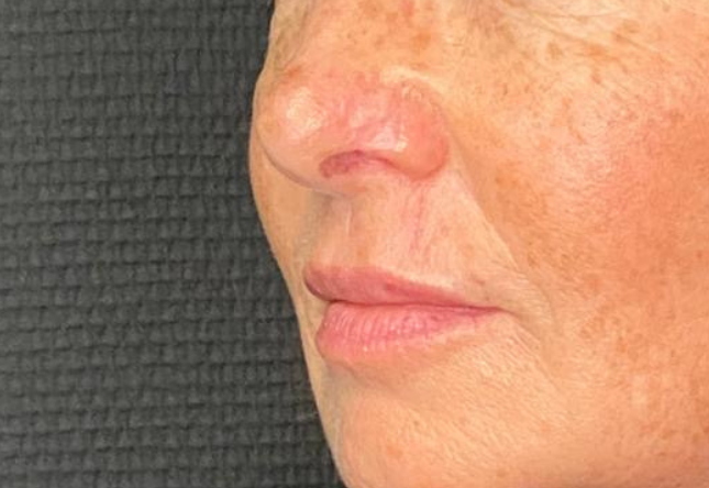 Après menton/jawline