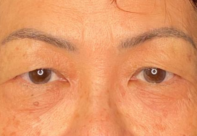 Avant blépharoplastie