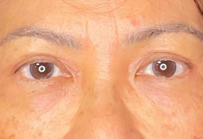 Après blépharoplastie