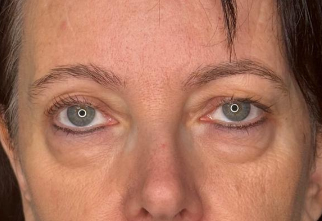 Avant blépharoplastie