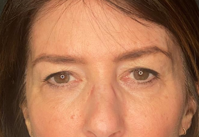 Avant blépharoplastie