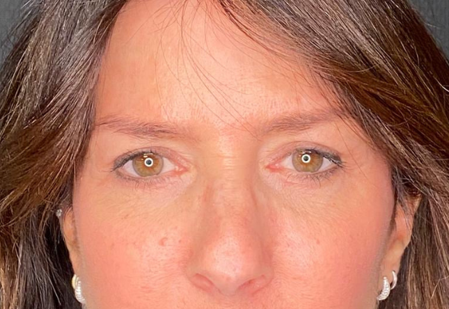 Après blépharoplastie