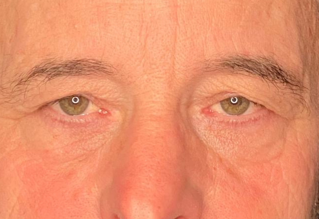Avant blépharoplastie