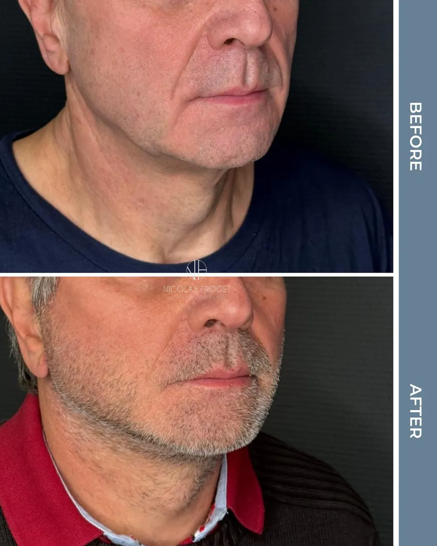 Lifting cervico-facial deep plane : photos avant et après, vue de trois-quarts, patient de 64 ans, résultat à 2 mois. Dr Nicolas Froget, Lyon