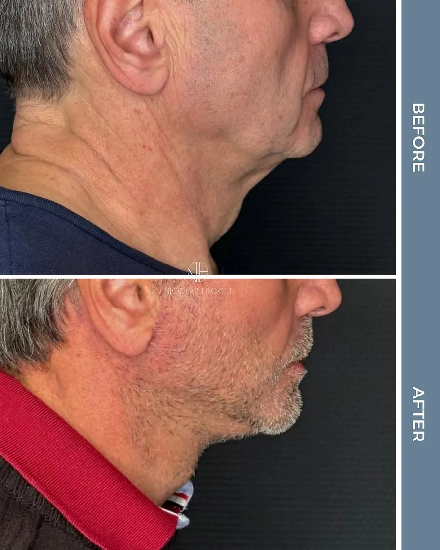 Lifting cervico-facial deep plane : photos avant et après, vue de profil, patient de 64 ans, résultat à 2 mois. Dr Nicolas Froget, Lyon