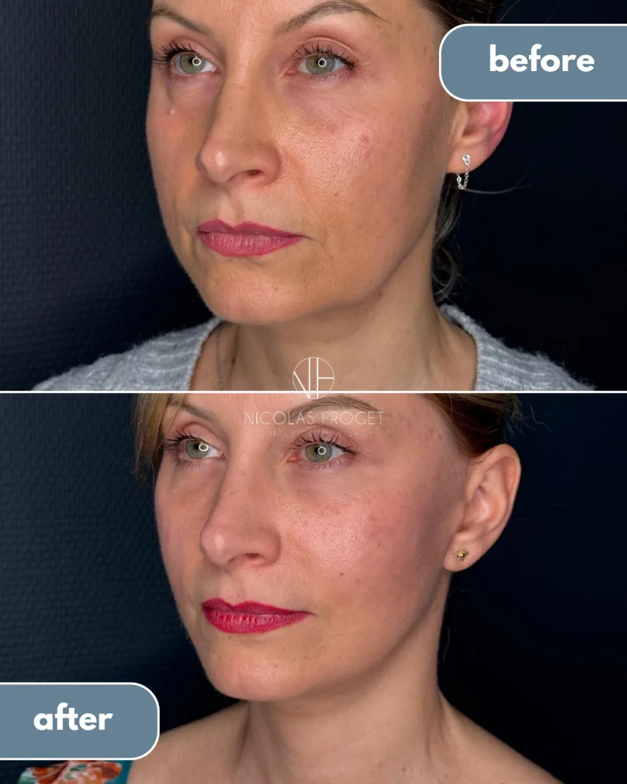 Lifting cervico-facial deep plane, blépharoplastie supérieure et lipofilling (microfat) des paupières inférieures : photos avant et après, vue de trois-quarts, patiente de 47 ans, résultat à 2 mois et demi. Dr Nicolas Froget, Lyon