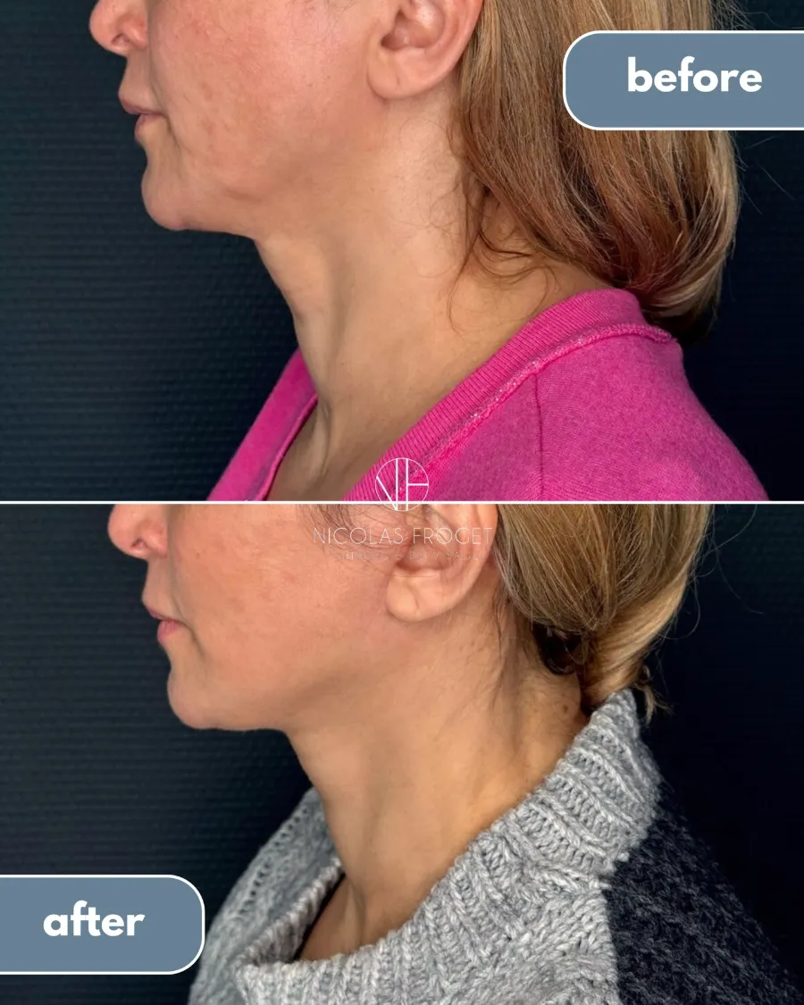 Lifting deep plane du visage et du cou, blépharoplastie supérieure et nanofat : photos avant et après, vue de profil, patiente de 50 ans, résultat à 4 mois. Dr Nicolas Froget, Lyon