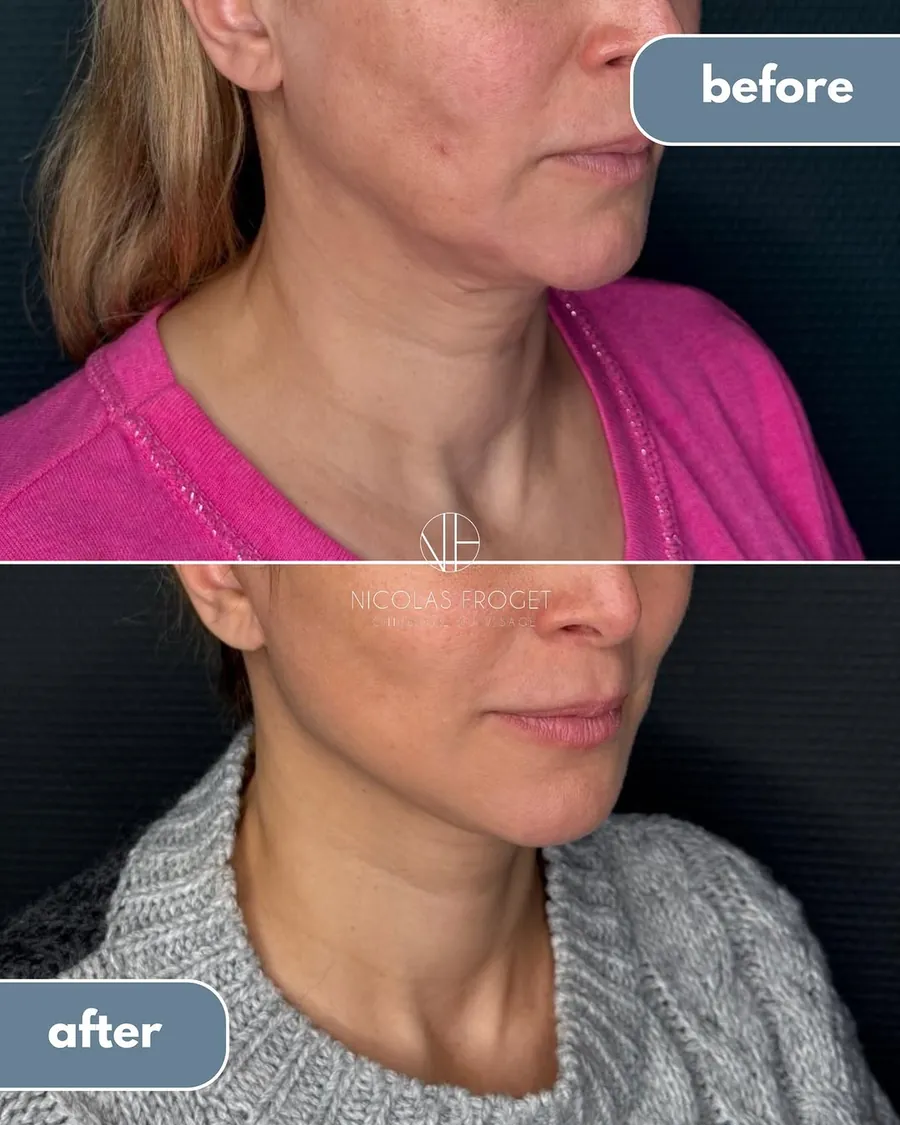 Lifting deep plane du visage et du cou, blépharoplastie supérieure et nanofat : photos avant et après, vue de trois-quarts, patiente de 50 ans, résultat à 4 mois. Dr Nicolas Froget, Lyon