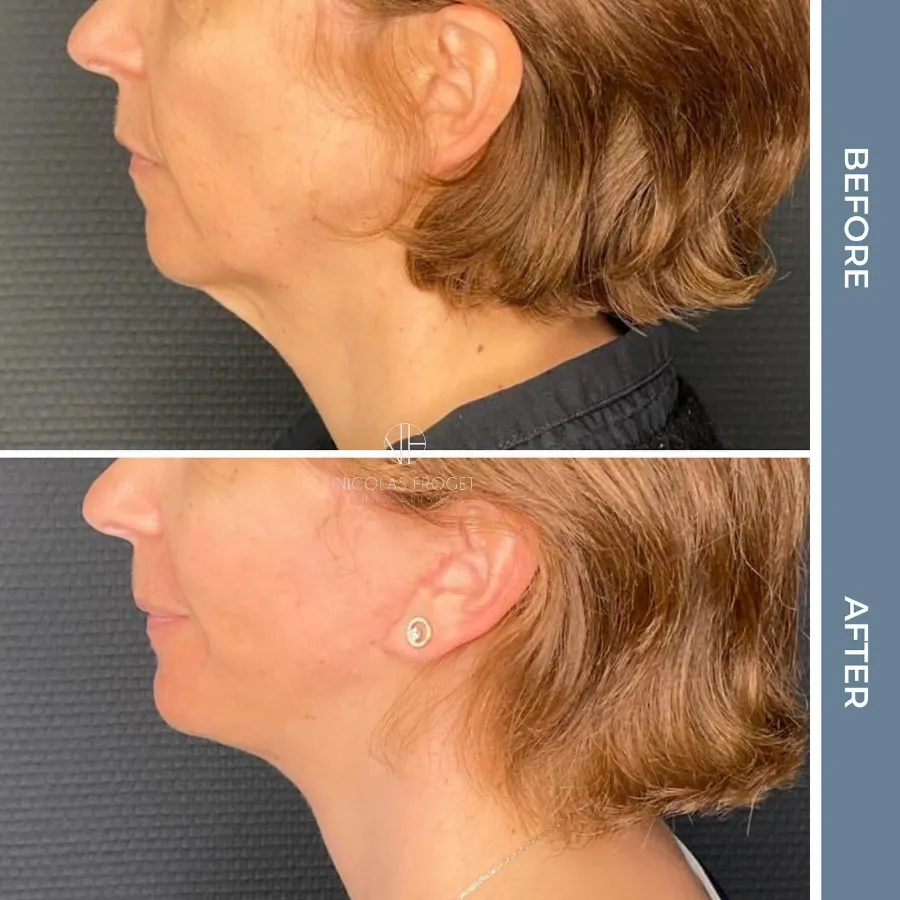 Lifting cervico-facial deep plane : photos avant et après, vue de profil, patiente de 52 ans, résultat à 3 mois. Dr Nicolas Froget, Lyon