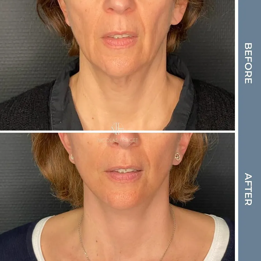 Lifting cervico-facial deep plane : photos avant et après, vue de face, patiente de 52 ans, résultat à 3 mois. Dr Nicolas Froget, Lyon