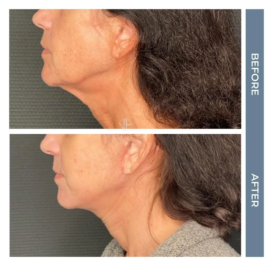 Lifting cervico-facial deep plane : photos avant et après, vue de profil, patiente de 53 ans, résultat à 3 mois. Dr Nicolas Froget, Lyon