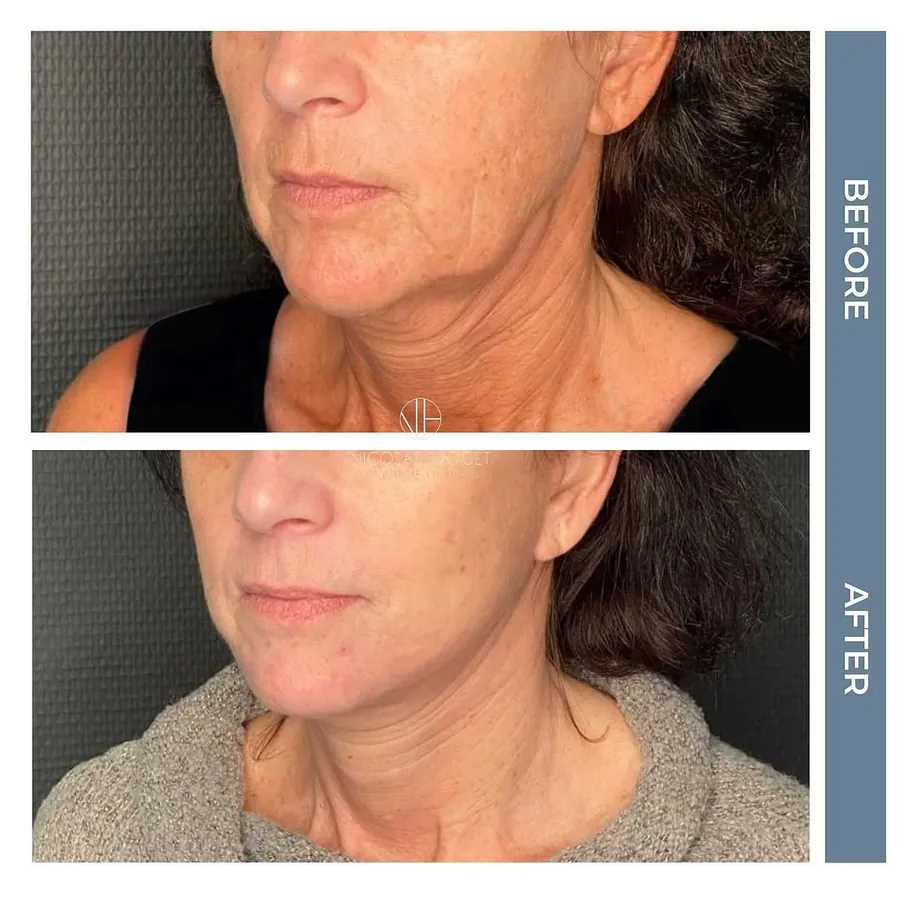 Lifting cervico-facial deep plane : photos avant et après, vue de trois-quarts, patiente de 53 ans, résultat à 3 mois. Dr Nicolas Froget, Lyon