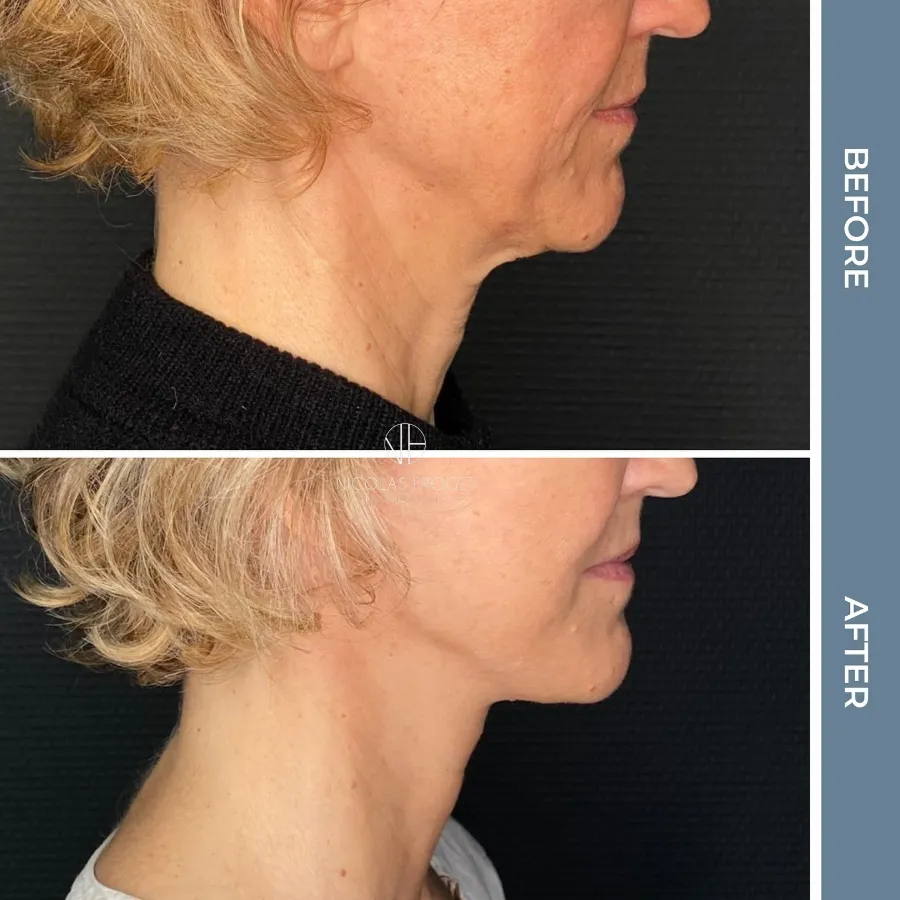 Lifting cervico-facial deep plane : photos avant et après, vue de profil, patiente de 53 ans, résultat à 2 mois. Dr Nicolas Froget, Lyon