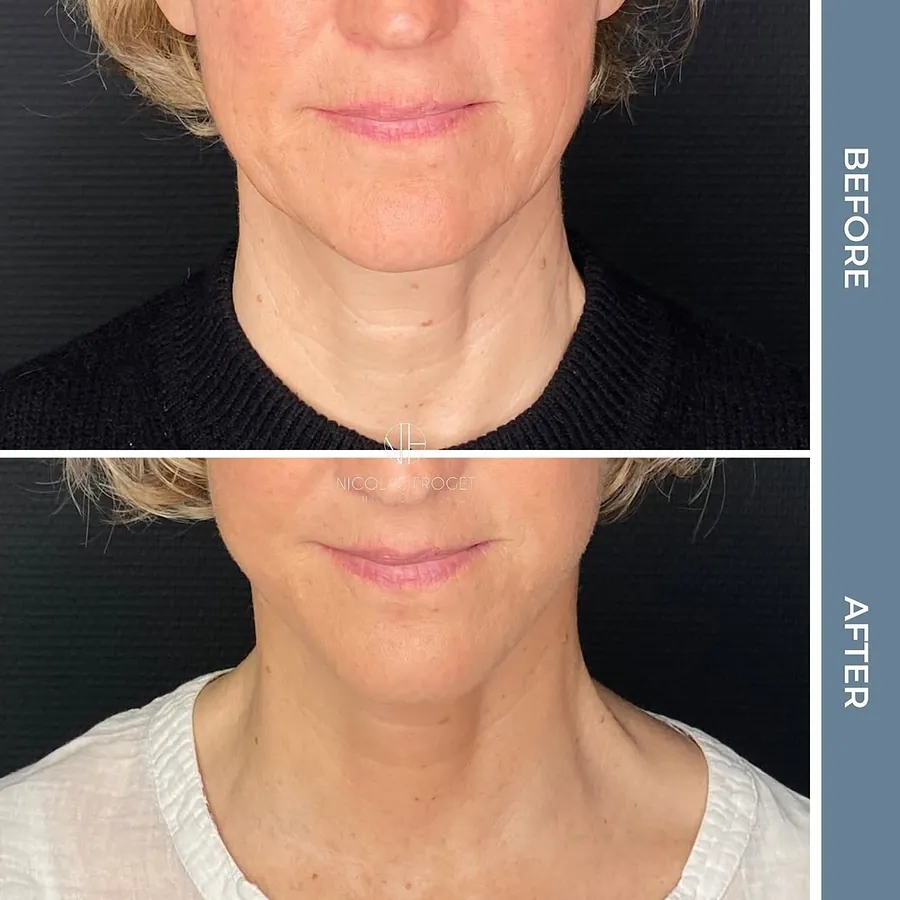Lifting cervico-facial deep plane : photos avant et après, vue de face, patiente de 53 ans, résultat à 2 mois. Dr Nicolas Froget, Lyon