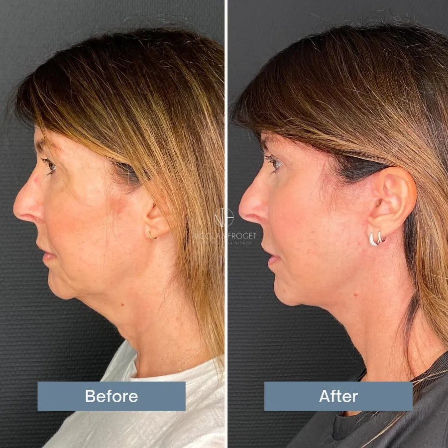 Lifting cervico-facial deep plane et blépharoplastie supérieure et inférieure : photos avant et après, vue de profil, patiente de 53 ans, résultat à 2 mois et demi. Dr Nicolas Froget, Lyon