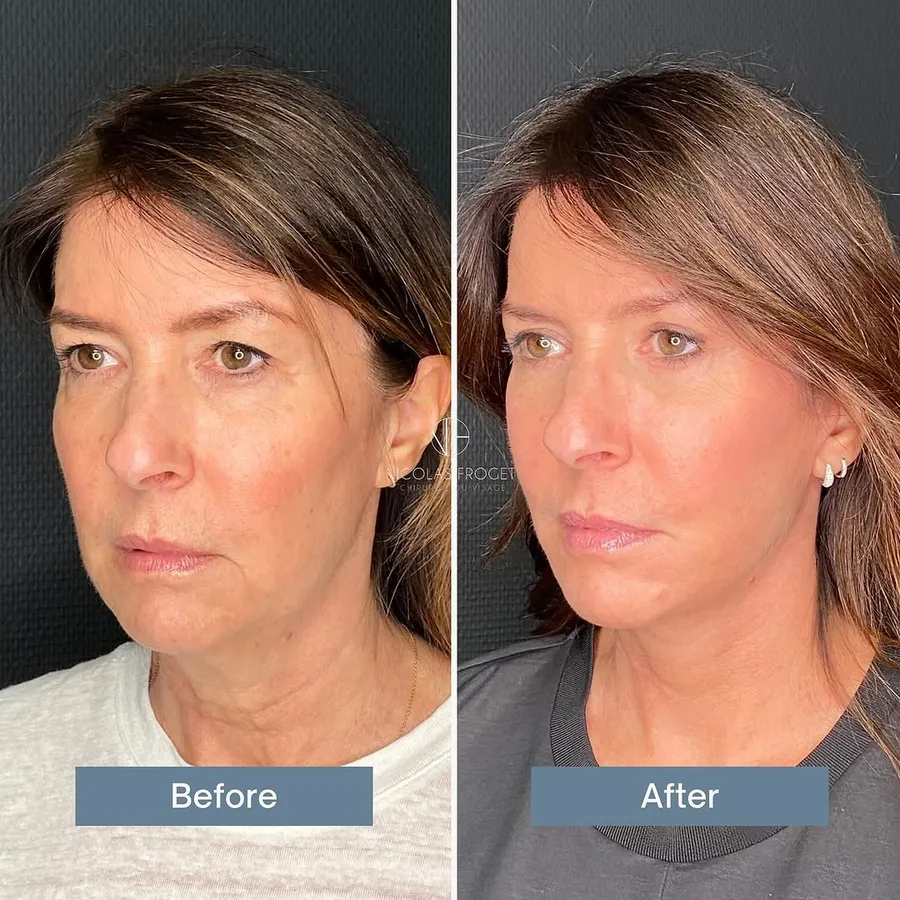 Lifting cervico-facial deep plane et blépharoplastie supérieure et inférieure : photos avant et après, vue de trois-quarts, patiente de 53 ans, résultat à 2 mois et demi. Dr Nicolas Froget, Lyon