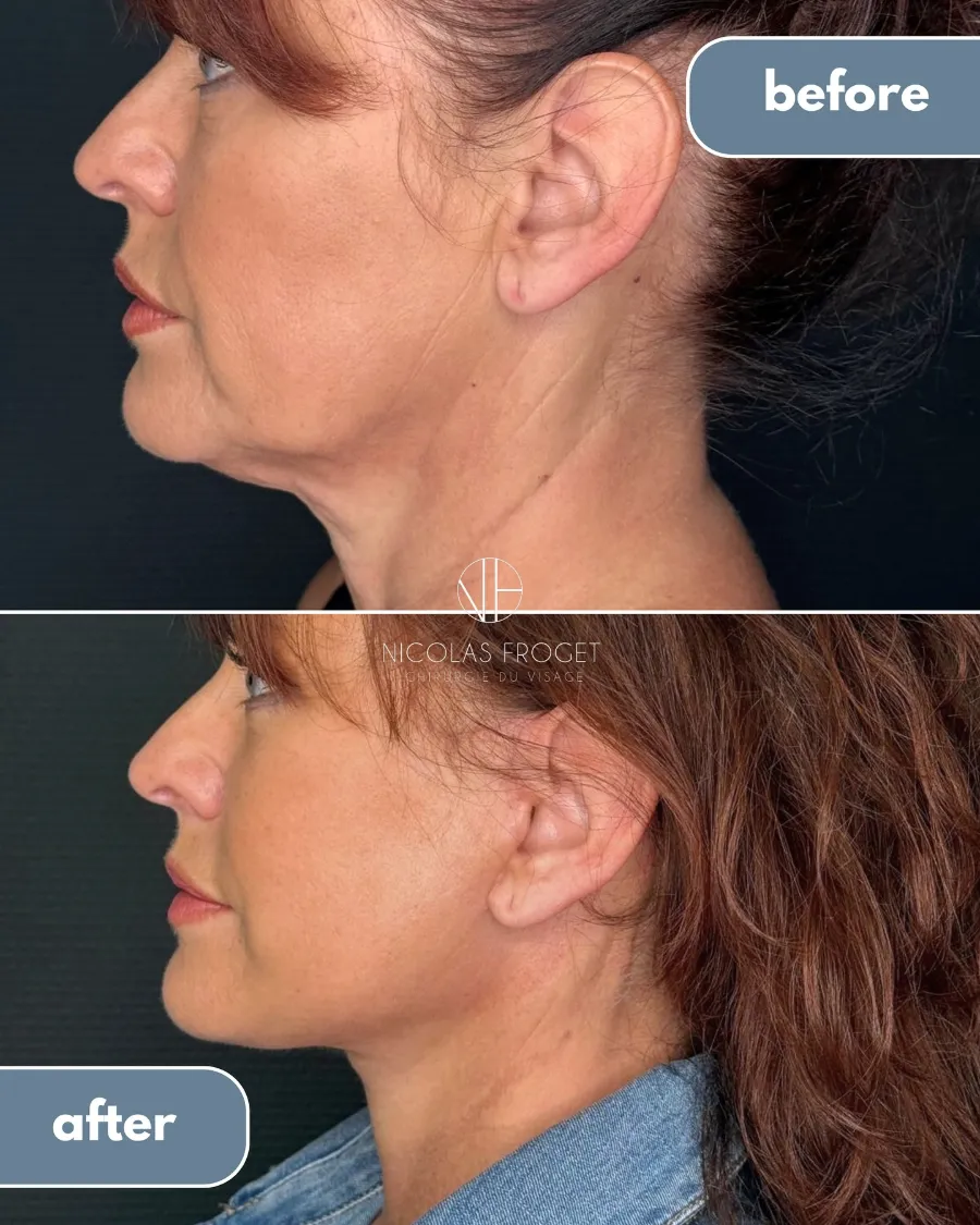 Lifting cervico-facial deep plane et blépharoplastie supérieure et inférieure : photos avant et après, vue de profil, patiente de 56 ans, résultat à 3 mois. Dr Nicolas Froget, Lyon