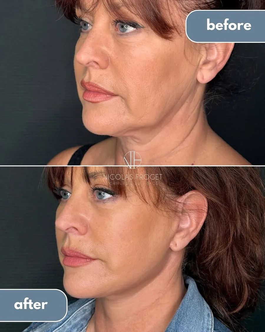 Lifting cervico-facial deep plane et blépharoplastie supérieure et inférieure : photos avant et après, vue de trois-quarts, patiente de 56 ans, résultat à 3 mois. Dr Nicolas Froget, Lyon