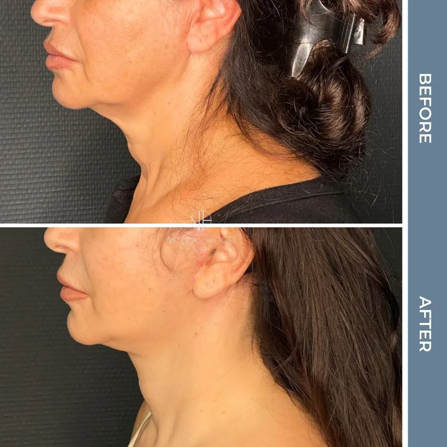 Lifting deep plane : photos avant et après, vue de profil, patiente de 57 ans, résultat à 3 mois. Dr Nicolas Froget, Lyon