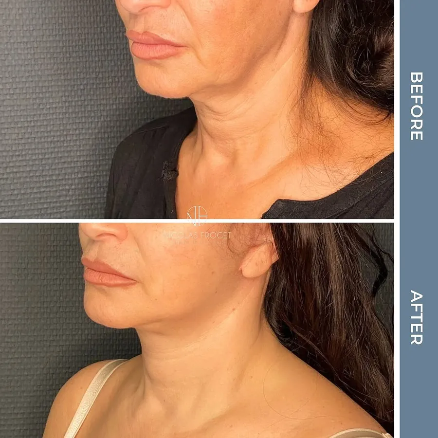 Lifting deep plane : photos avant et après, vue de trois-quarts, patiente de 57 ans, résultat à 3 mois. Dr Nicolas Froget, Lyon