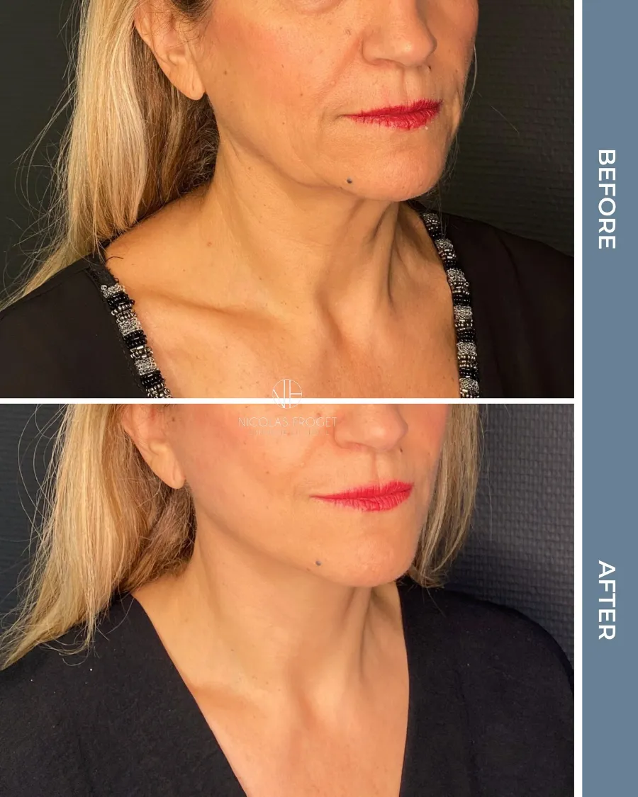 Lifting cervico-facial deep plane : photos avant et après, vue de trois-quarts, patiente de 60 ans, résultat à 2 mois. Dr Nicolas Froget, Lyon