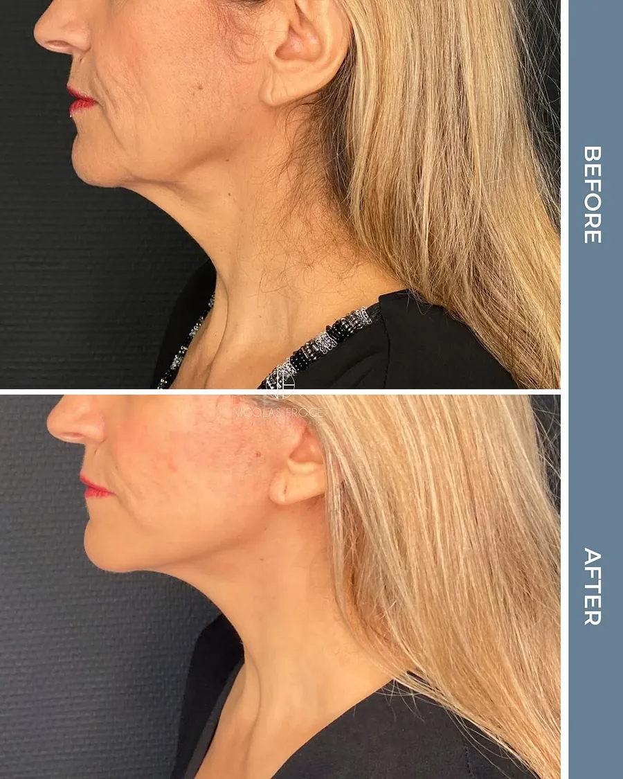 Lifting cervico-facial deep plane : photos avant et après, vue de profil, patiente de 60 ans, résultat à 2 mois. Dr Nicolas Froget, Lyon
