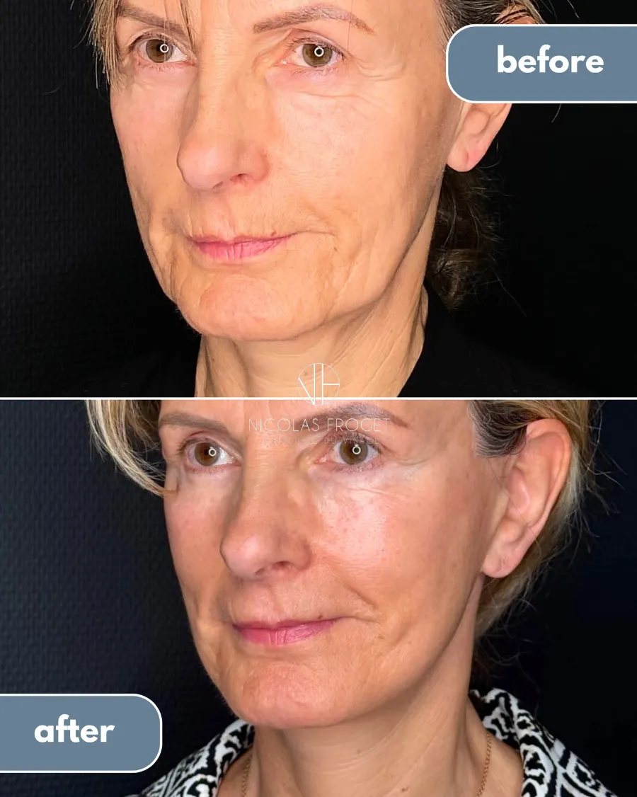 Lifting cervico-facial deep plane et blépharoplastie supérieure et inférieure : photos avant et après, vue de trois-quarts, patiente de 60 ans, résultat à 1 an. Dr Nicolas Froget, Lyon