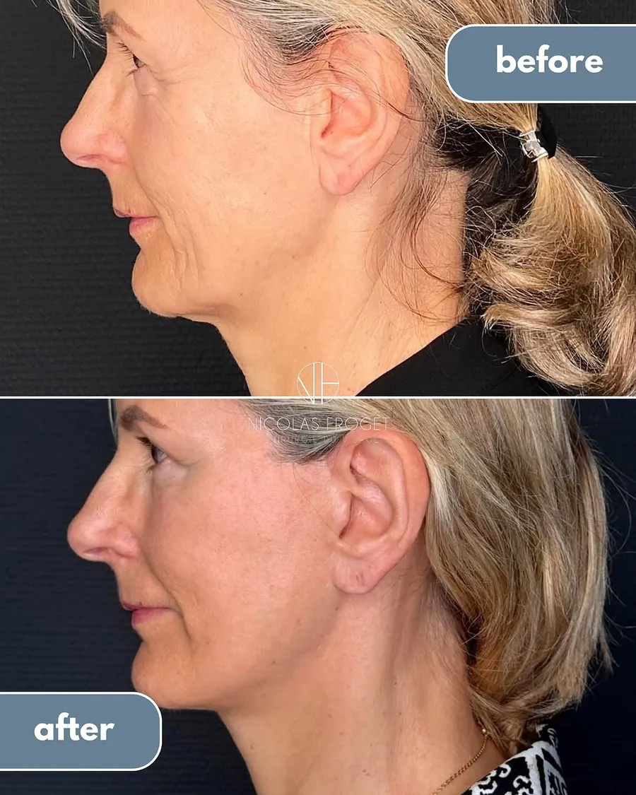 Lifting cervico-facial deep plane et blépharoplastie supérieure et inférieure : photos avant et après, vue de profil, patiente de 60 ans, résultat à 1 an. Dr Nicolas Froget, Lyon