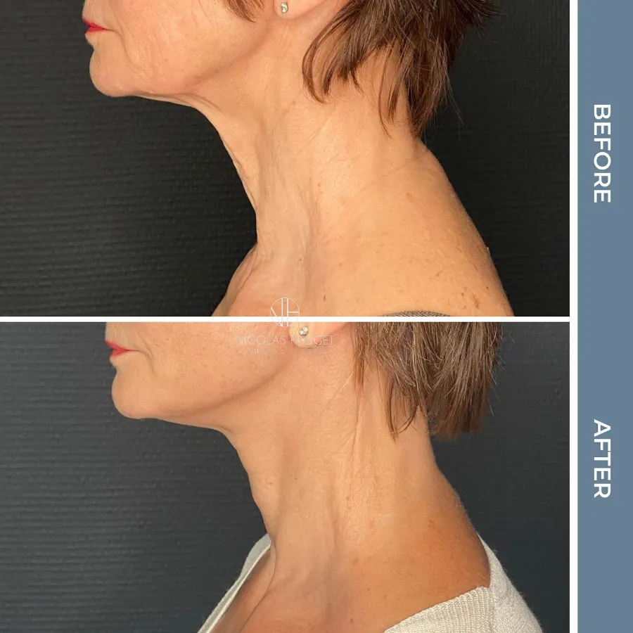 Lifting cervico-facial : photos avant et après, vue de profil, patiente de 63 ans, résultat à 2 mois. Dr Nicolas Froget, Lyon