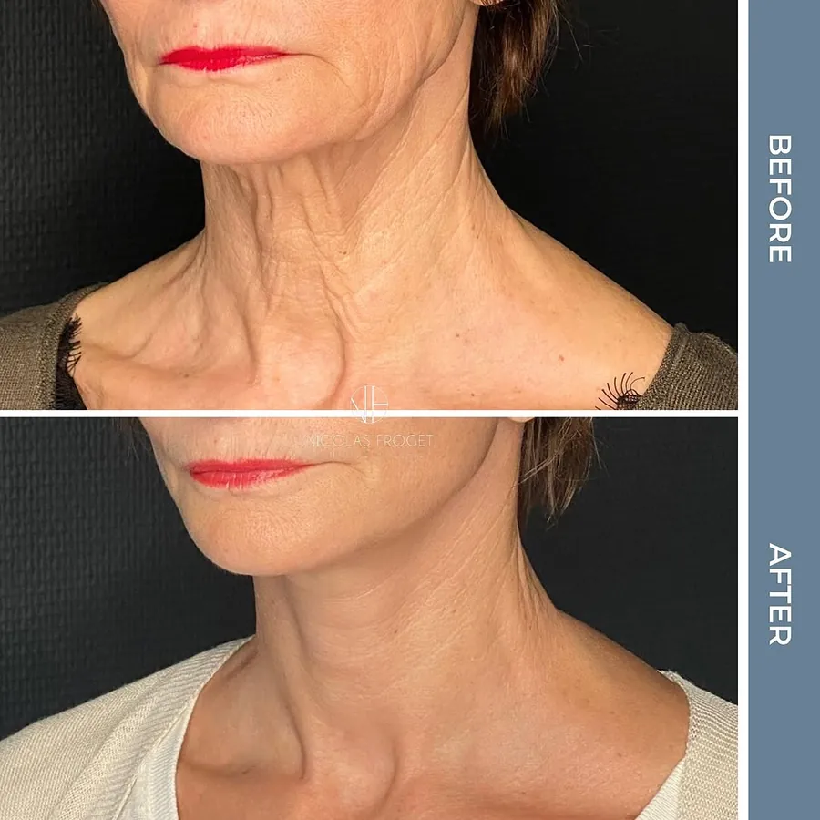 Lifting cervico-facial : photos avant et après, vue de trois-quarts, patiente de 63 ans, résultat à 2 mois. Dr Nicolas Froget, Lyon