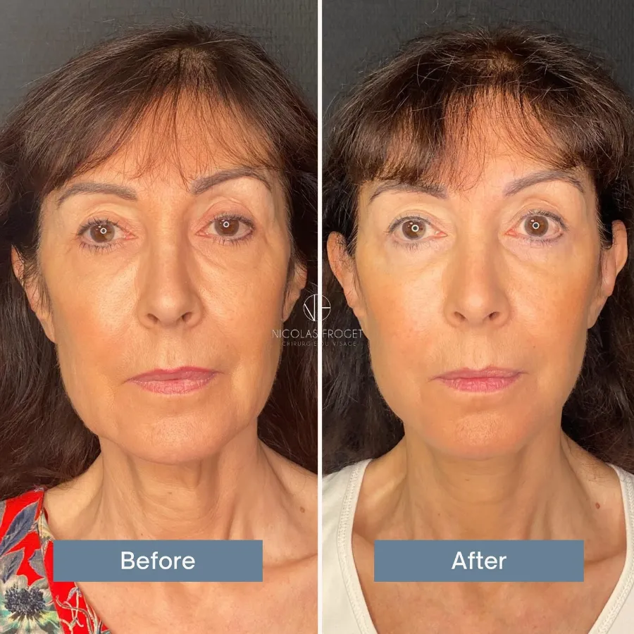 Lifting cervico-facial deep plane et blépharoplastie inférieure : photos avant et après, vue de face, patiente de 63 ans, résultat à 10 mois. Dr Nicolas Froget, Lyon