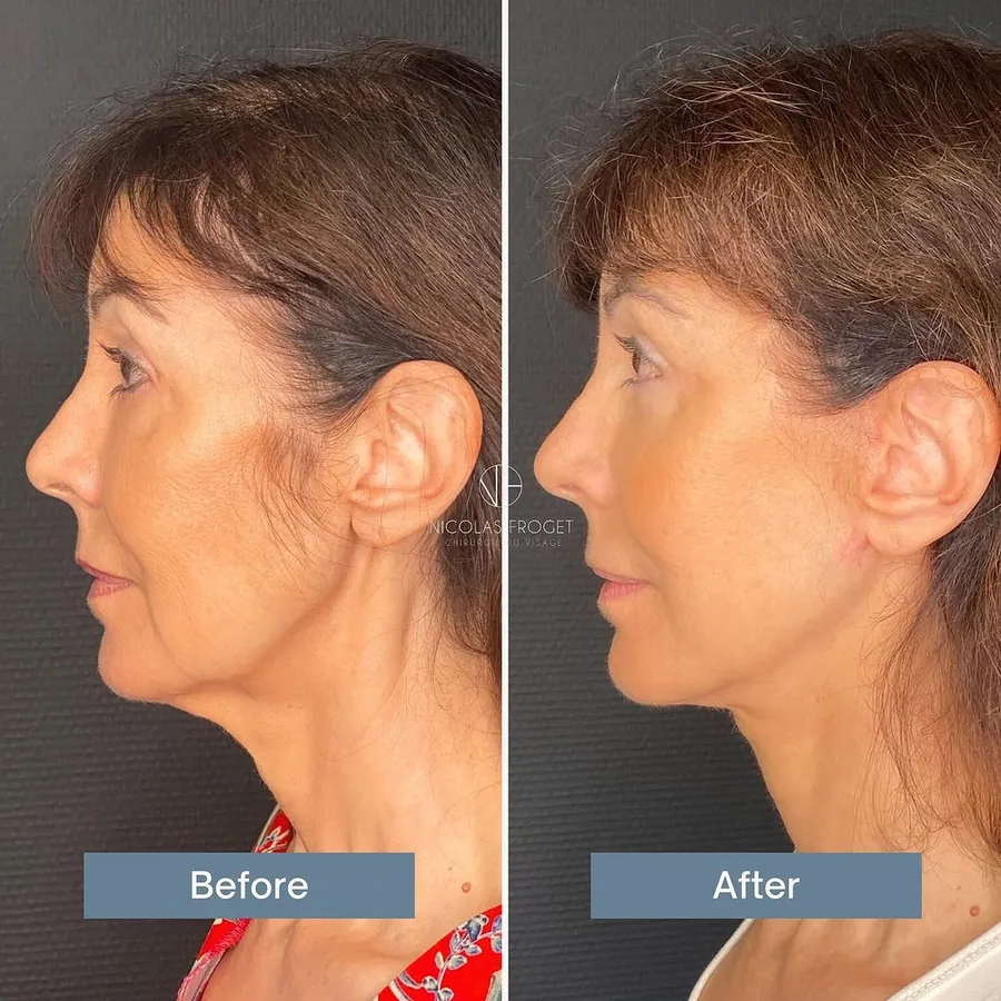 Lifting cervico-facial deep plane et blépharoplastie inférieure : photos avant et après, vue de profil, patiente de 63 ans, résultat à 10 mois. Dr Nicolas Froget, Lyon