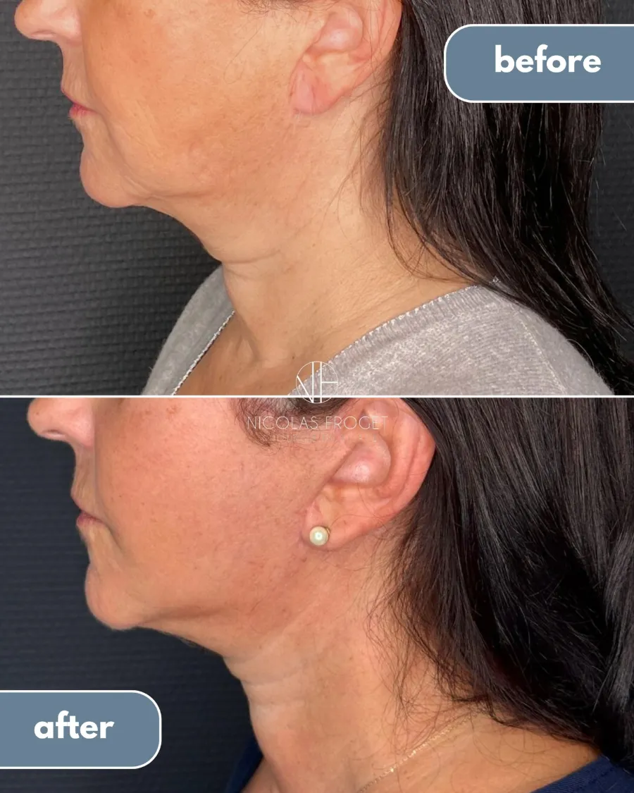 Reprise de lifting en technique deep plane, après un premier lifting réalisé ailleurs : photos avant et après, vue de profil, patiente de 65 ans. Dr Nicolas Froget, Lyon