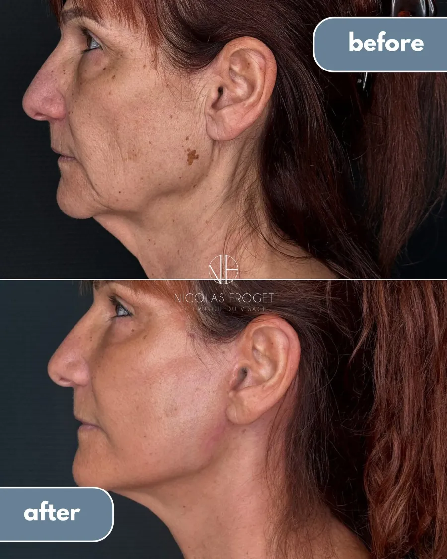 Lifting cervico-facial deep plane et blépharoplastie supérieure et inférieure : photos avant et après, vue de profil, patiente de 66 ans, résultat à 2 mois. Dr Nicolas Froget, Lyon