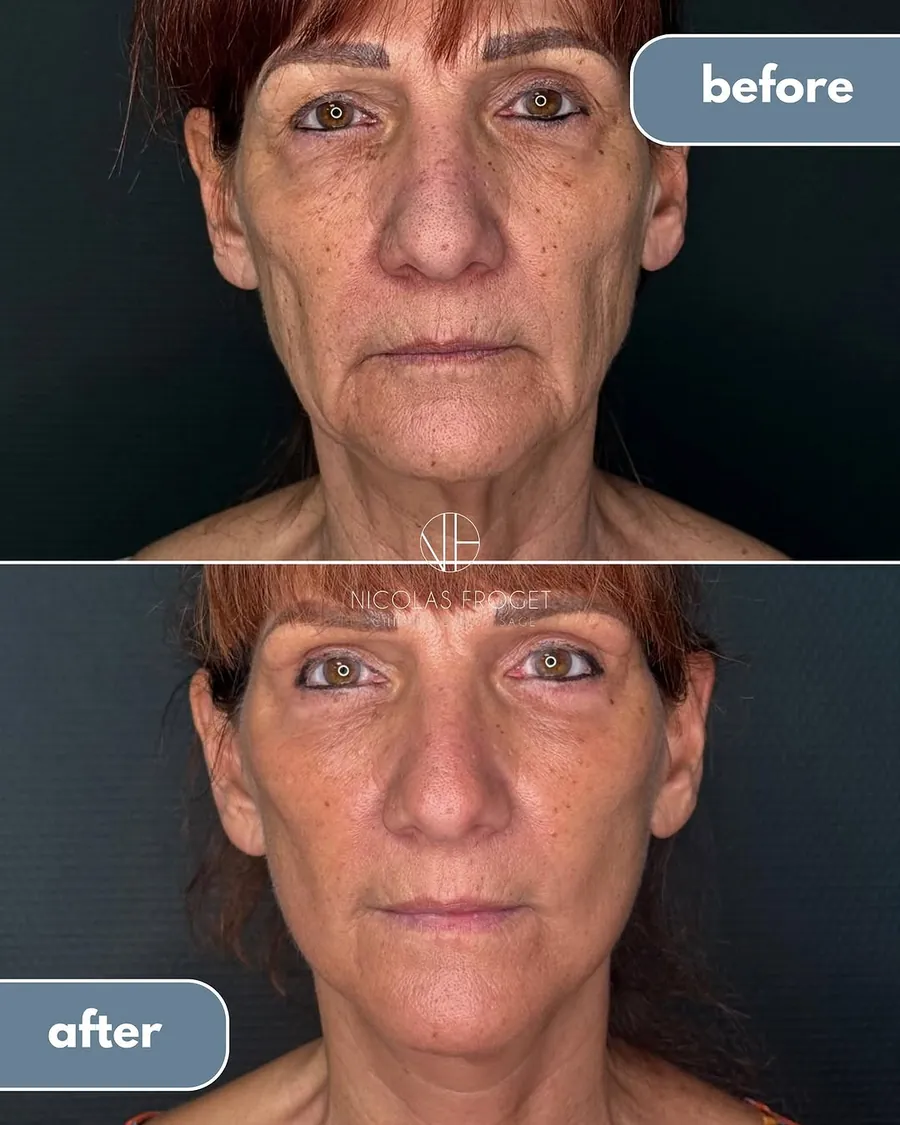 Lifting cervico-facial deep plane et blépharoplastie supérieure et inférieure : photos avant et après, vue de face, patiente de 66 ans, résultat à 2 mois. Dr Nicolas Froget, Lyon