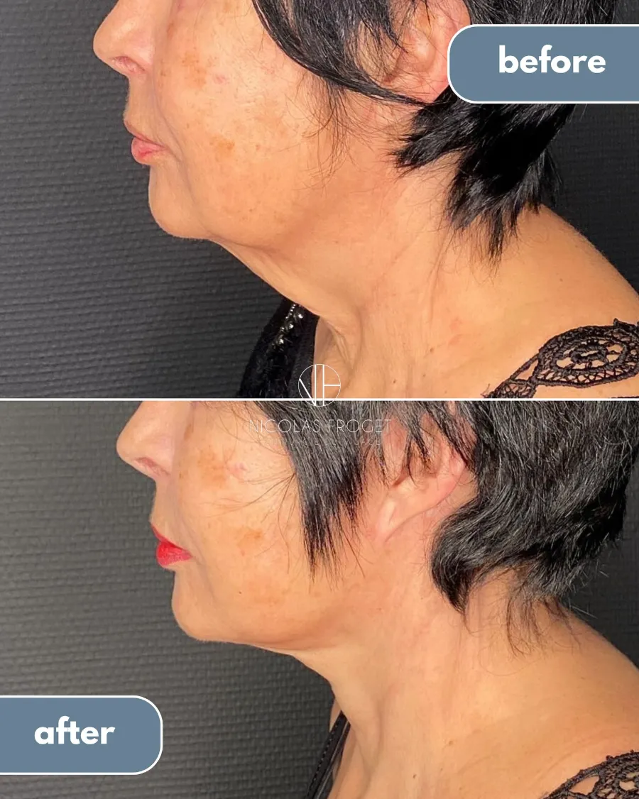 Lifting deep plane et lipoaspiration sous-mentonnière : photos avant et après, vue de profil, patiente de 67 ans, résultat à 11 mois. Dr Nicolas Froget, Lyon