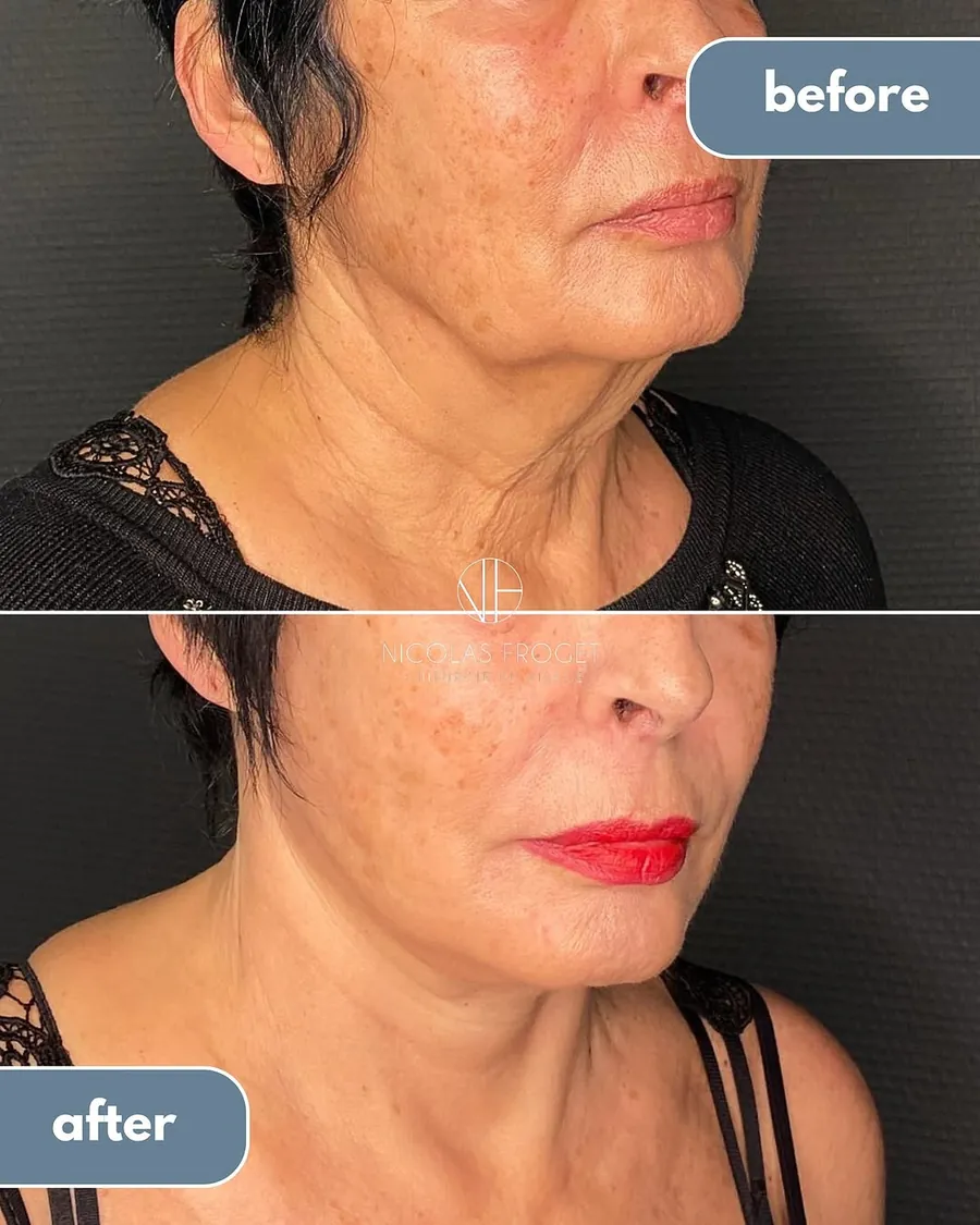 Lifting deep plane et lipoaspiration sous-mentonnière : photos avant et après, vue de trois-quarts, patiente de 67 ans, résultat à 11 mois. Dr Nicolas Froget, Lyon