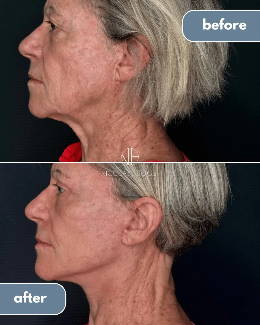Lifting deep plane et blépharoplastie supérieure et inférieure : photos avant et après, vue de profil, patiente de 73 ans, résultat à 2 mois et demi. Dr Nicolas Froget, Lyon