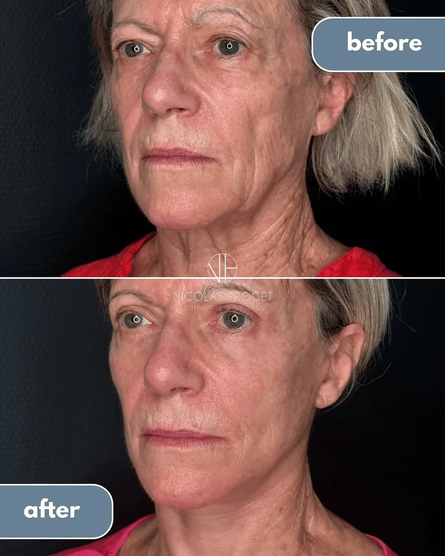 Lifting deep plane et blépharoplastie supérieure et inférieure : photos avant et après, vue de trois-quarts, patiente de 73 ans, résultat à 2 mois et demi. Dr Nicolas Froget, Lyon