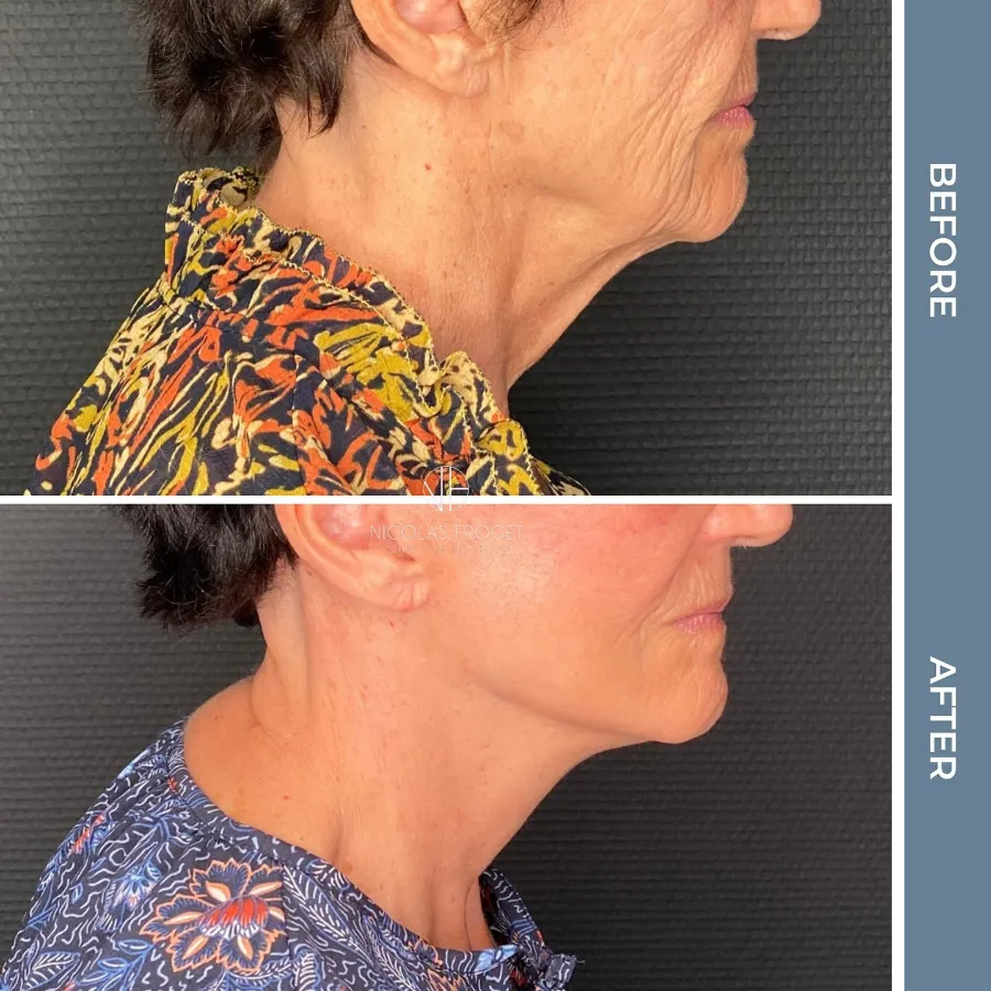 Lifting cervico-facial deep plane : photos avant et après, vue de profil, patiente de 74 ans, résultat à 9 mois. Dr Nicolas Froget, Lyon