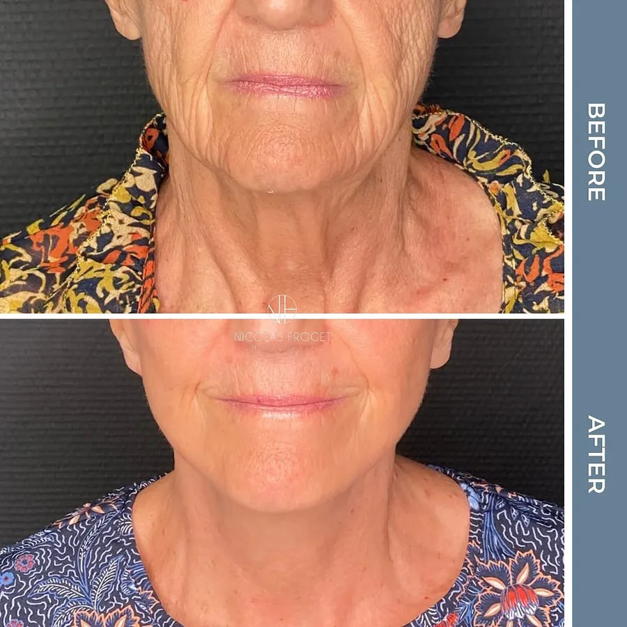 Lifting cervico-facial deep plane : photos avant et après, vue de face, patiente de 74 ans, résultat à 9 mois. Dr Nicolas Froget, Lyon